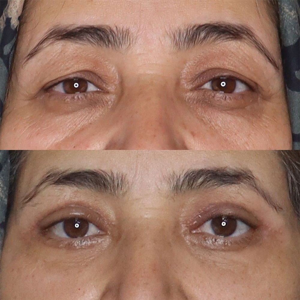 عمل بینی اقساطی
